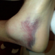 Illustration for article titled Take A Gander At Brett Favres Disgusting Bruises